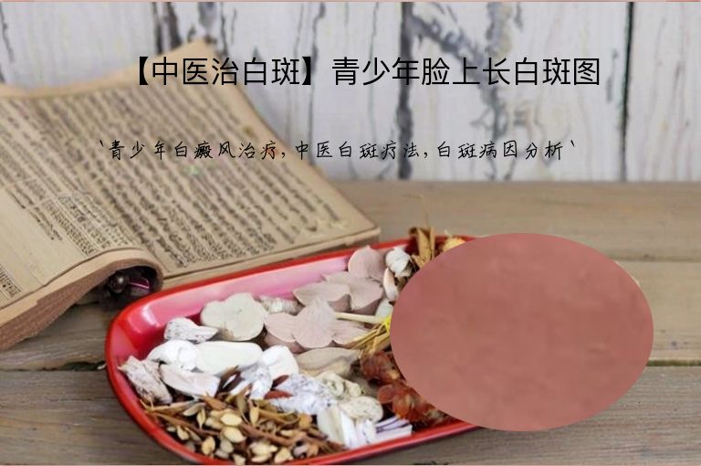 【中医治白斑】青少年脸上长白斑图”