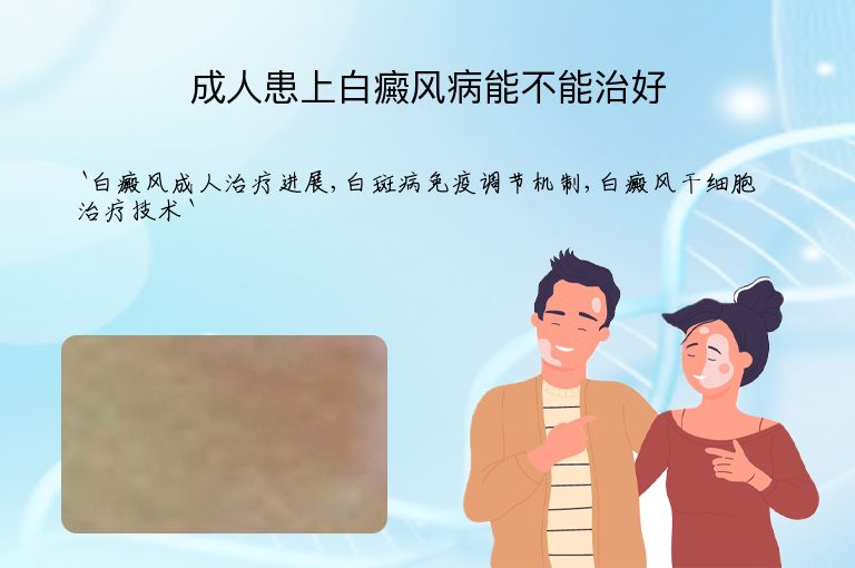 成人患上白癜风病能不能治好”