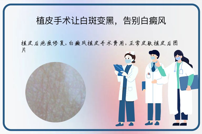 植皮手术让白斑变黑，告别白癜风”