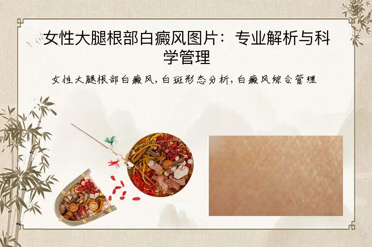 女性大腿根部白癜风图片：专业解析与科学管理”