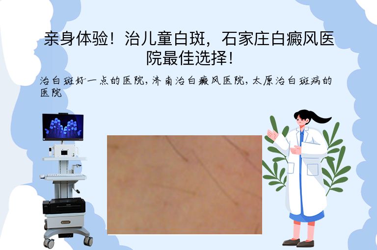 亲身体验!治儿童白斑,石家庄白癜风医院最佳选择!”