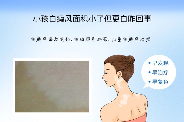 小孩白癜风面积小了但更白咋回事”