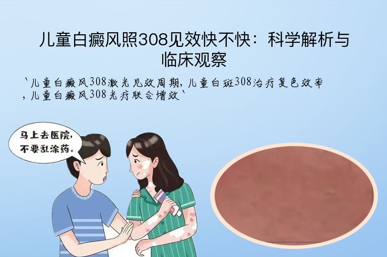 儿童白癜风照308见效快不快:科学解析与临床观察
