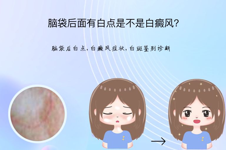 脑袋后面有白点是不是白癜风？”