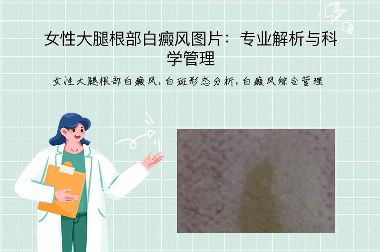 女性大腿根部白癜风图片：专业解析与科学管理”