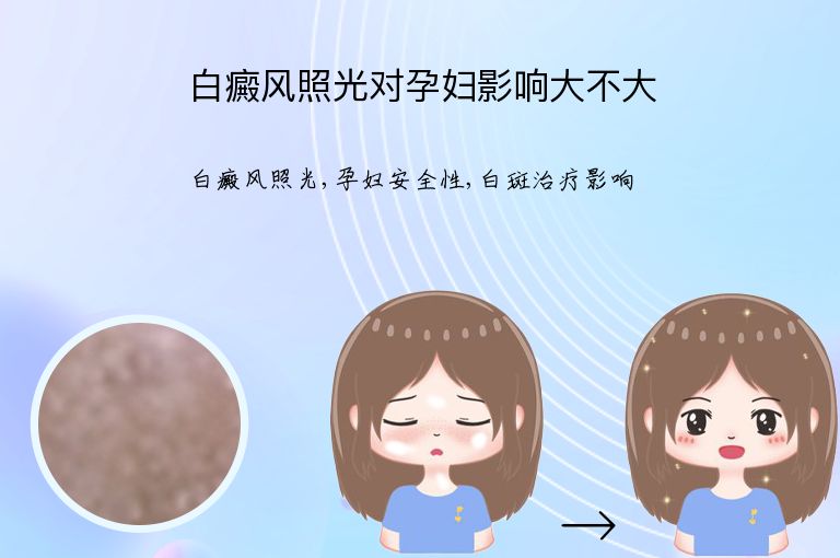 白癜风照光对孕妇影响大不大”