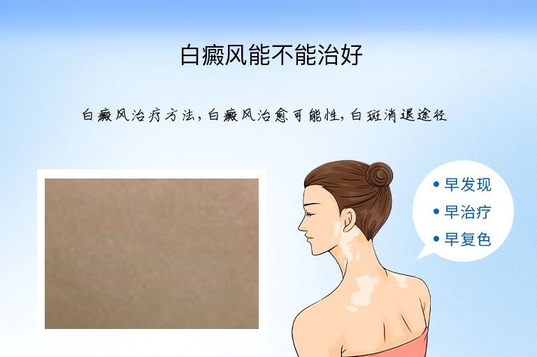 白癜风能不能治好”