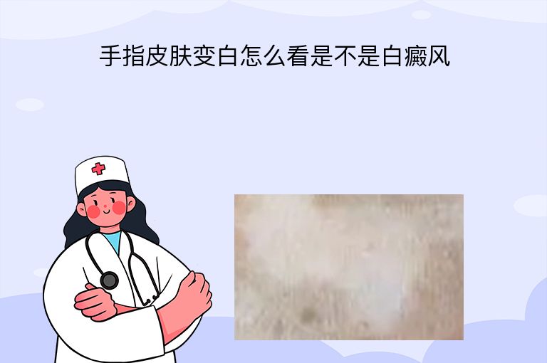 手指皮肤变白怎么看是不是白癜风