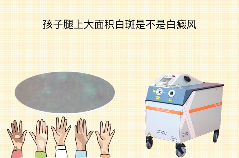 孩子腿上大面积白斑是不是白癜风