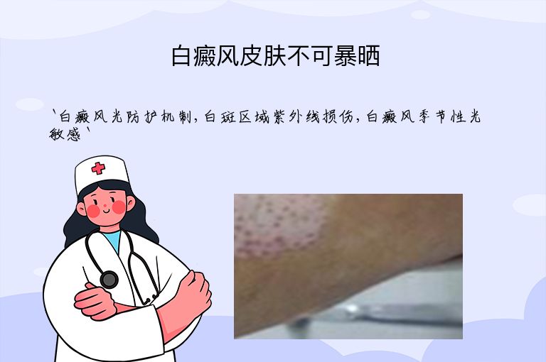 白癜风皮肤不可暴晒