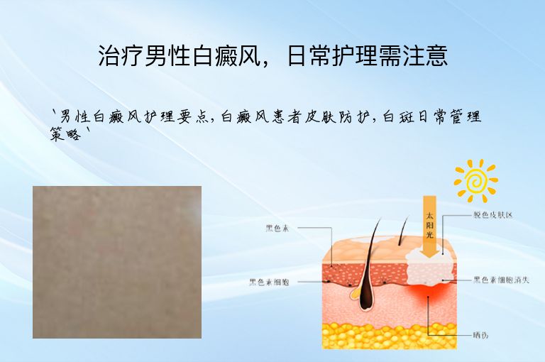 治疗男性白癜风,日常护理需注意