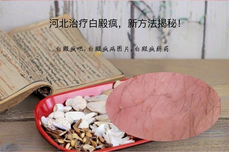 河北治疗白殿疯，新方法揭秘！”