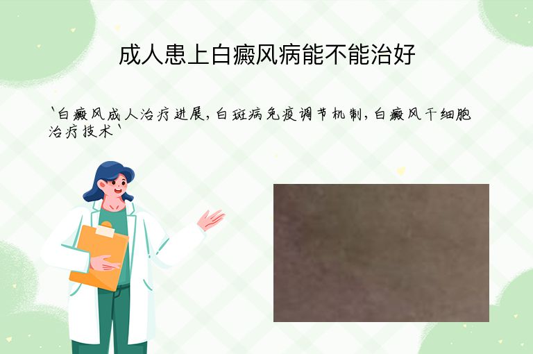 成人患上白癜风病能不能治好”