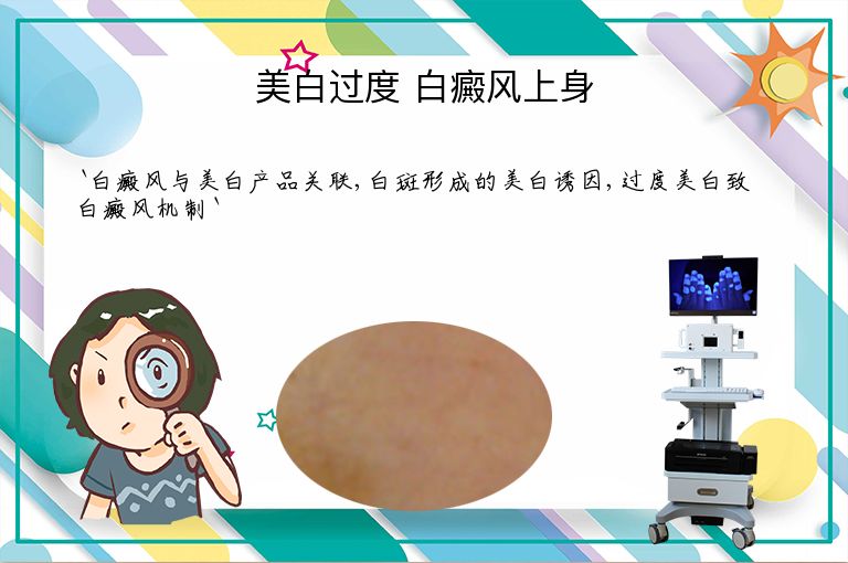 美白过度 白癜风上身”