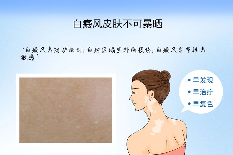 白癜风皮肤不可暴晒