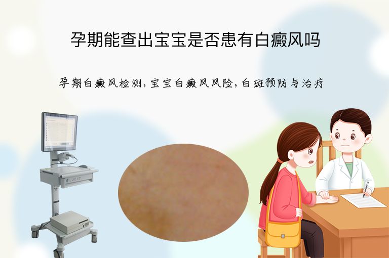孕期能查出宝宝是否患有白癜风吗”
