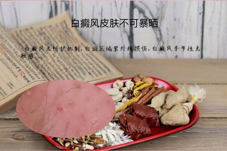 白癜风皮肤不可暴晒