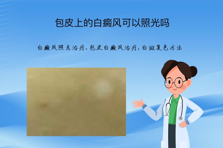包皮上的白癜风可以照光吗”
