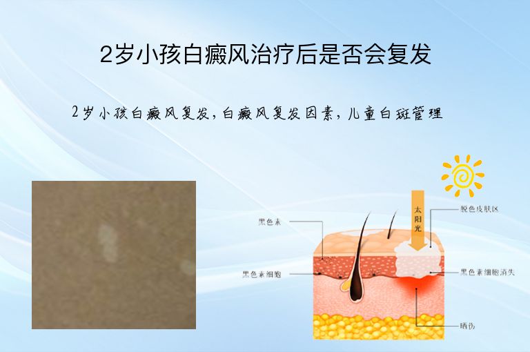 2岁小孩白癜风治疗后是否会复发”