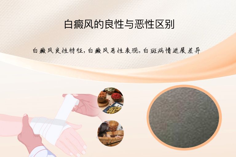 白癜风的良性与恶性区别”