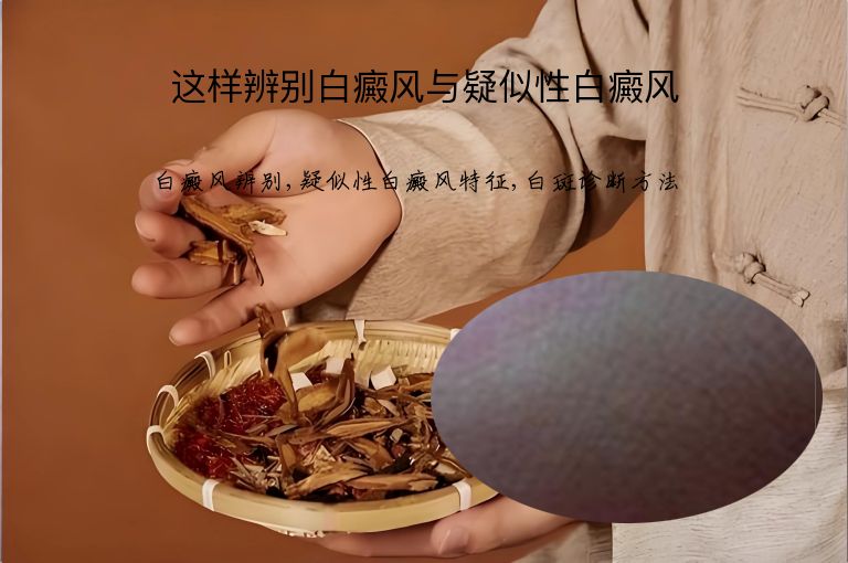这样辨别白癜风与疑似性白癜风”