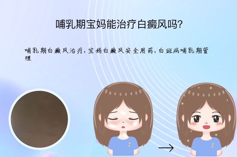 哺乳期宝妈能治疗白癜风吗？”