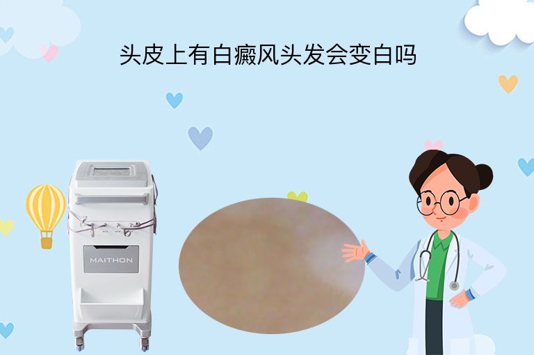 头皮上有白癜风头发会变白吗