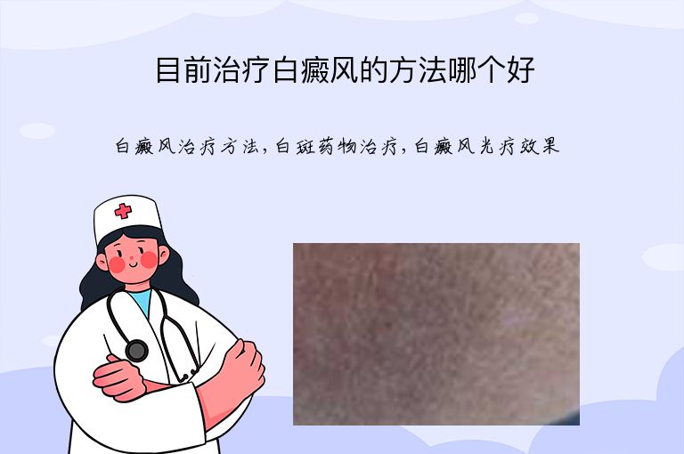 目前治疗白癜风的方法哪个好”
