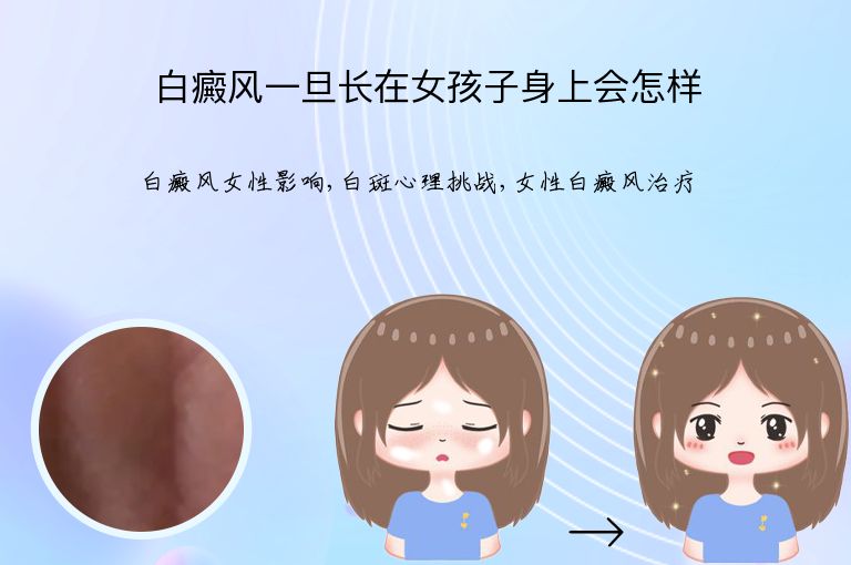 白癜风一旦长在女孩子身上会怎样”