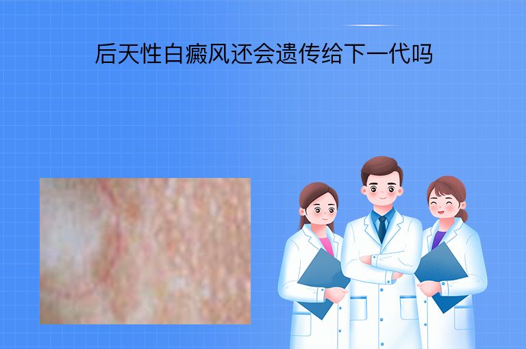 后天性白癜风还会遗传给下一代吗”