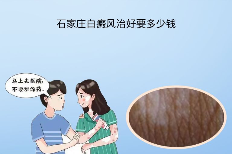 石家庄白癜风治好要多少钱”