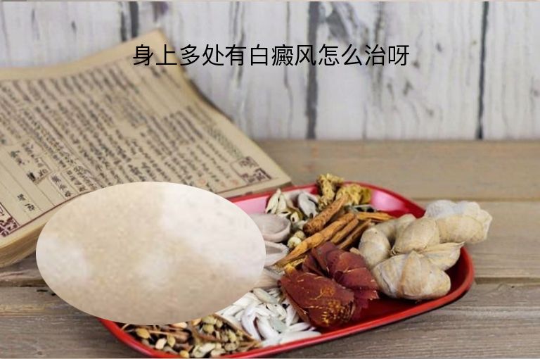 身上多处有白癜风怎么治呀”