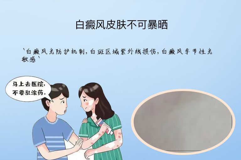 白癜风皮肤不可暴晒