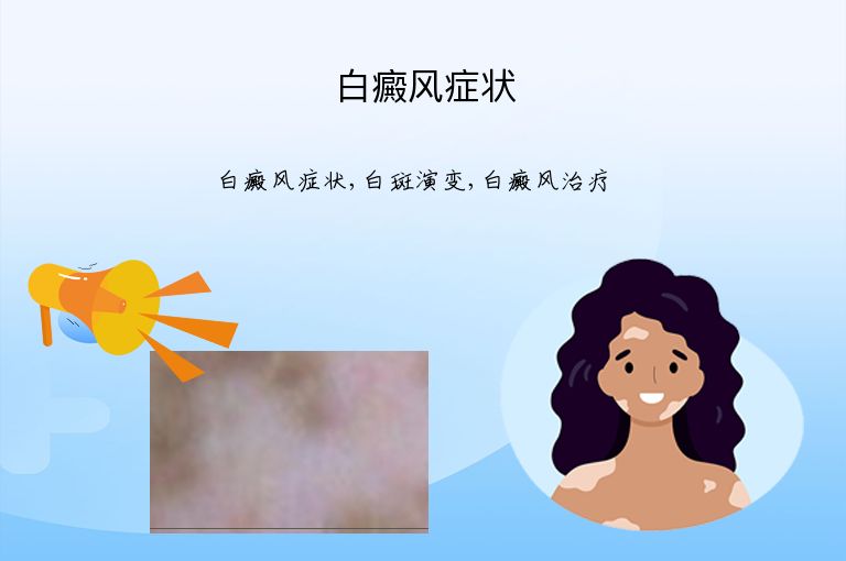 白癜风症状”