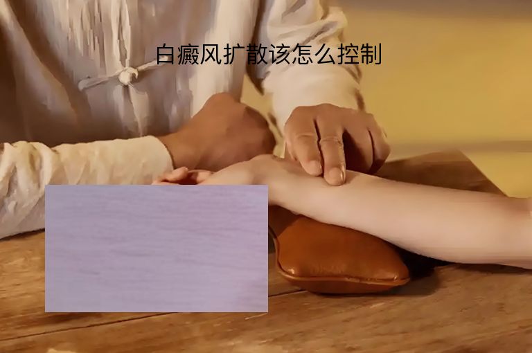 白癜风扩散该怎么控制”