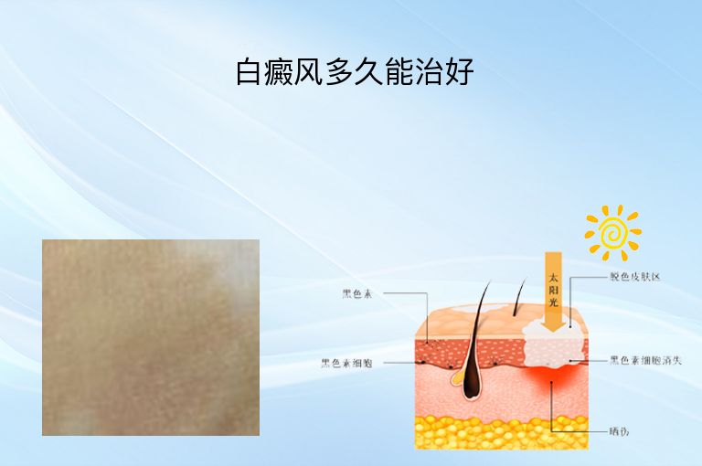 白癜风多久能治好”