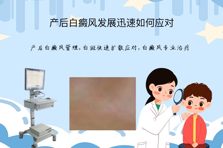 产后白癜风发展迅速如何应对”