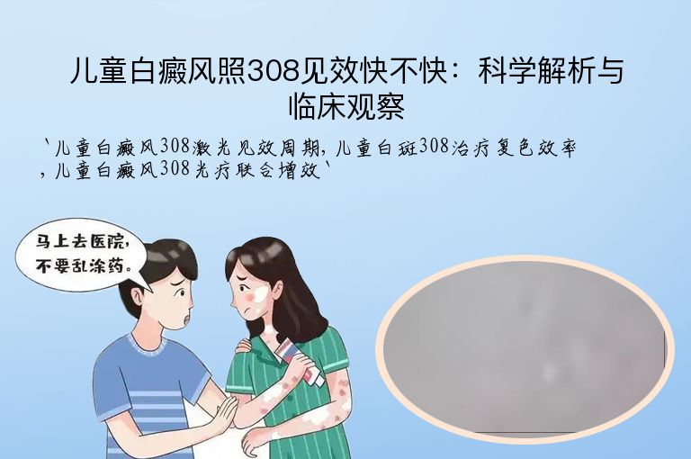 儿童白癜风照308见效快不快：科学解析与临床观察