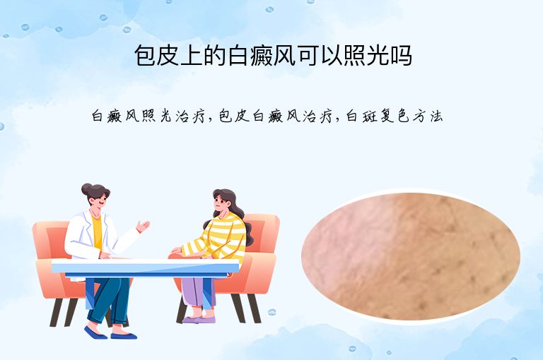包皮上的白癜风可以照光吗”
