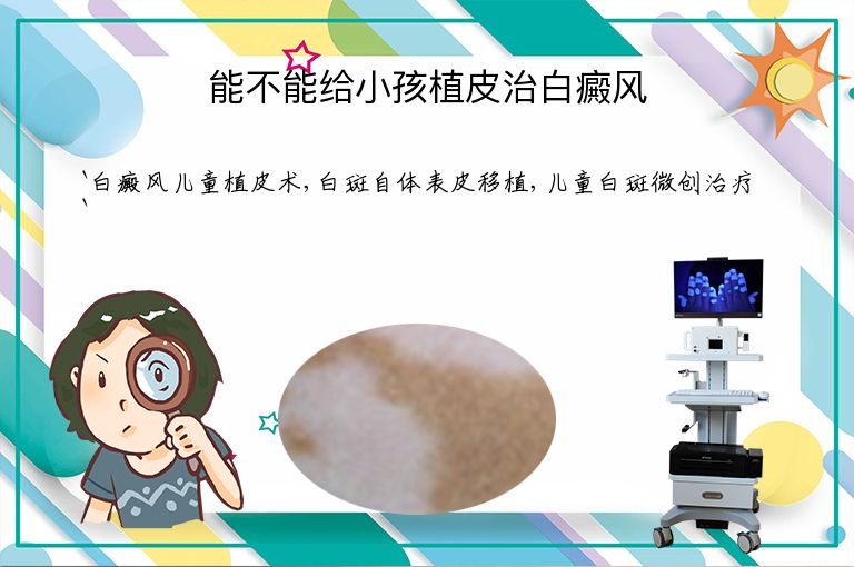 能不能给小孩植皮治白癜风”
