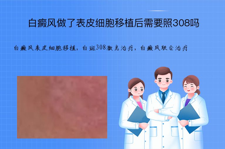 白癜风做了表皮细胞移植后需要照308吗”