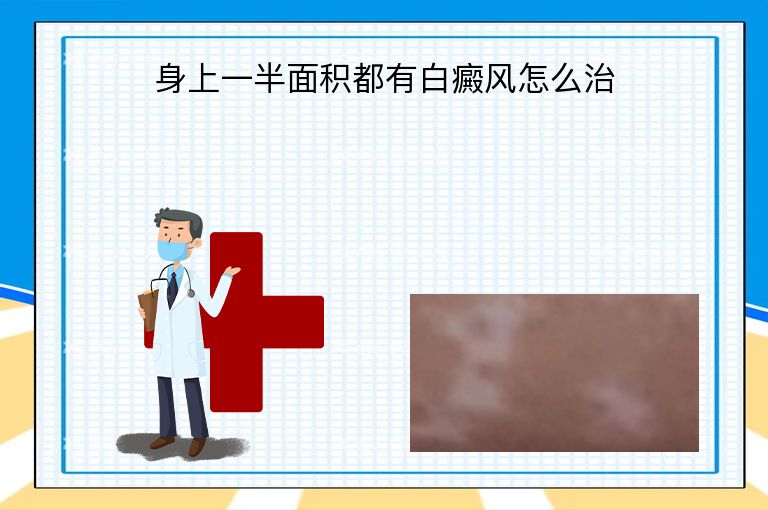 身上一半面积都有白癜风怎么治”