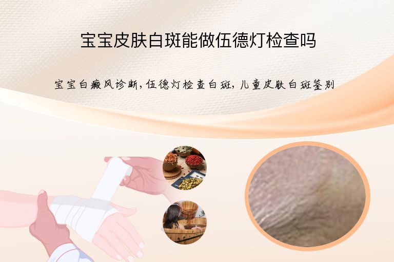 宝宝皮肤白斑能做伍德灯检查吗”