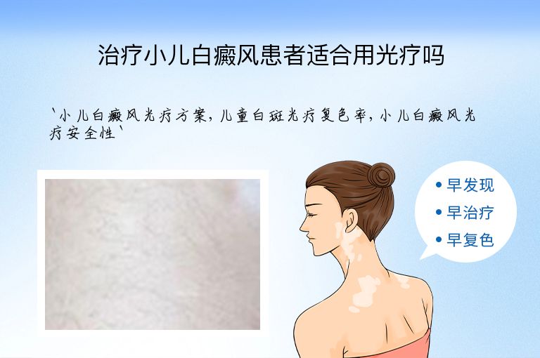 治疗小儿白癜风患者适合用光疗吗
