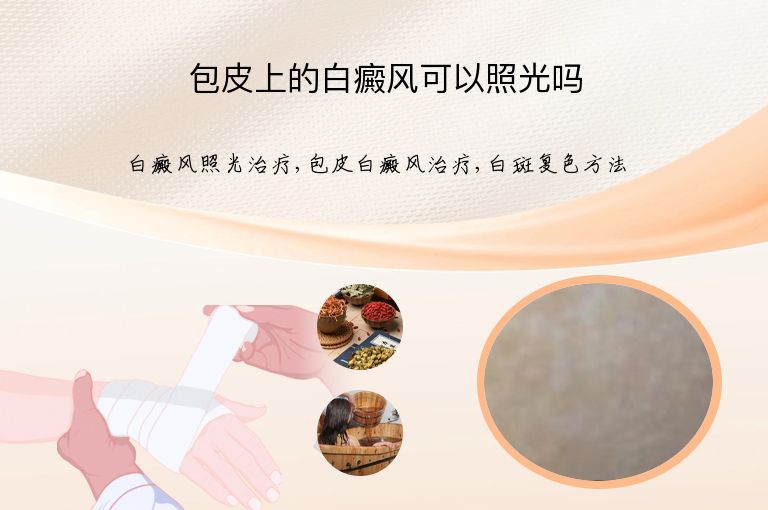 包皮上的白癜风可以照光吗”