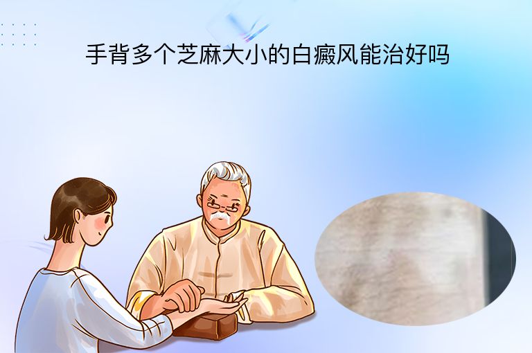 手背多个芝麻大小的白癜风能治好吗