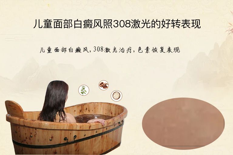儿童面部白癜风照308激光的好转表现”