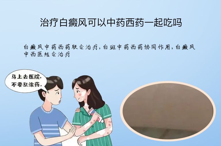 治疗白癜风可以中药西药一起吃吗”