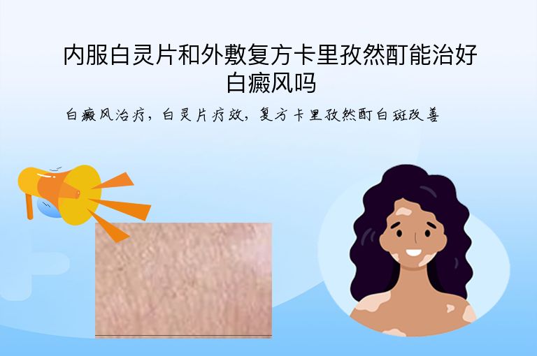 内服白灵片和外敷复方卡里孜然酊能治好白癜风吗”