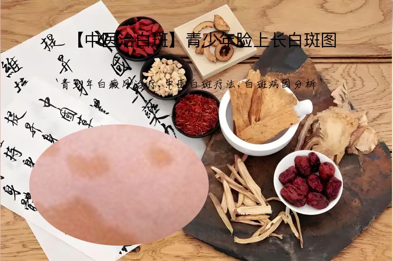 【中医治白斑】青少年脸上长白斑图”